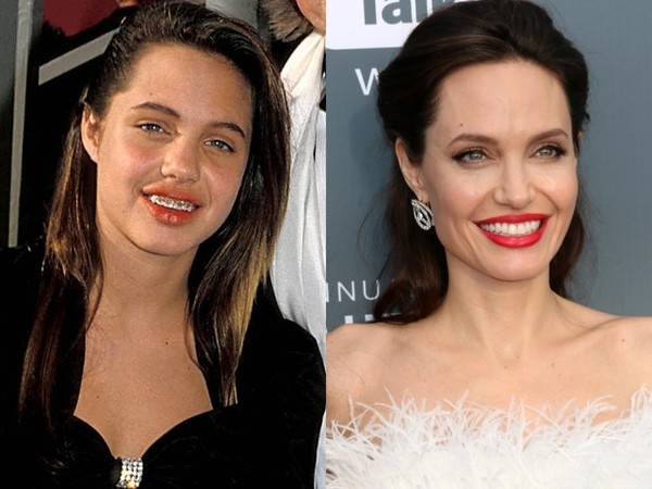 13 звезд, которые носили брекеты: впечатляющие фото до и после