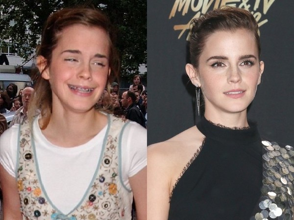 13 звезд, которые носили брекеты: впечатляющие фото до и после