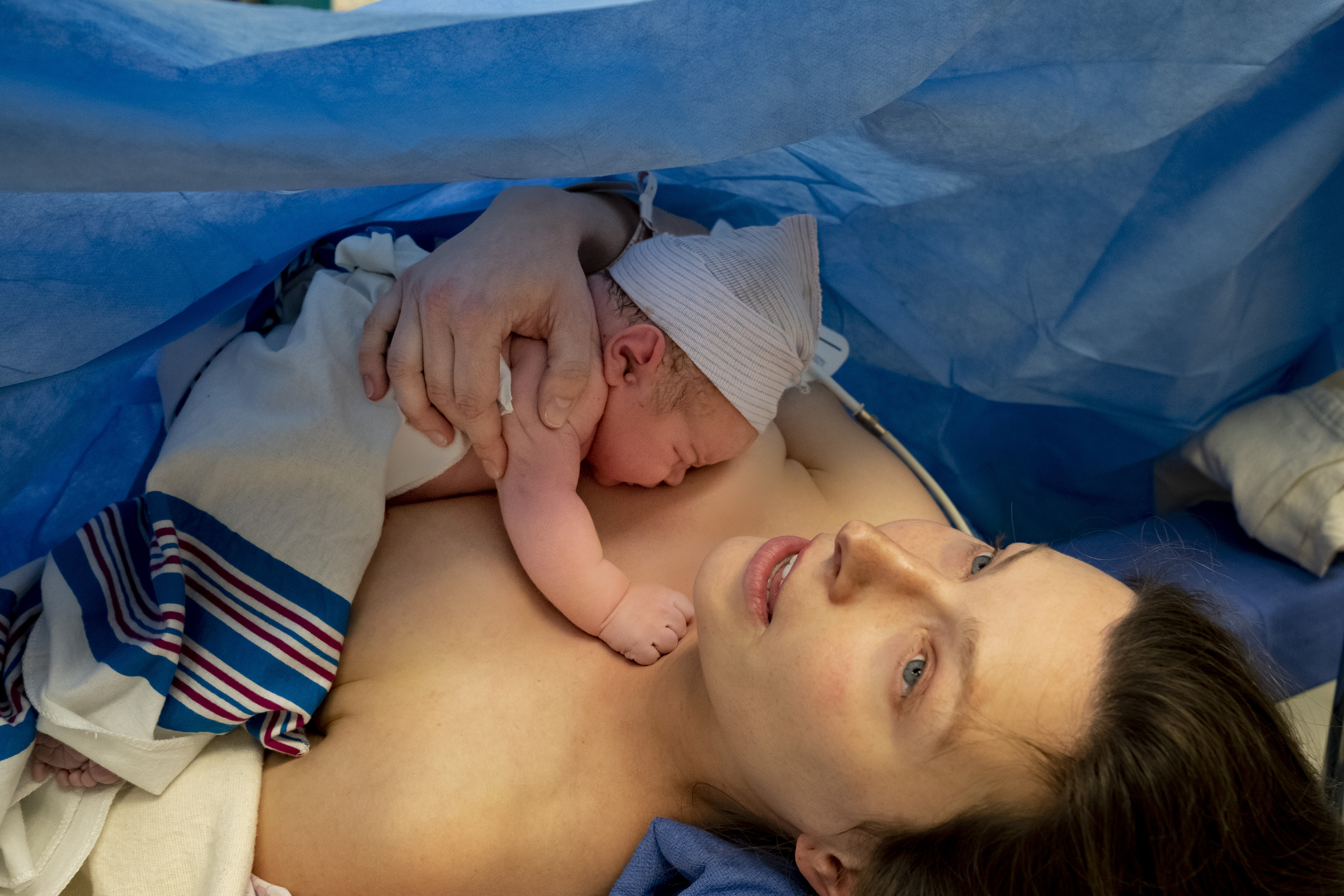 клинически и анатомически узкий таз при беременности и родах