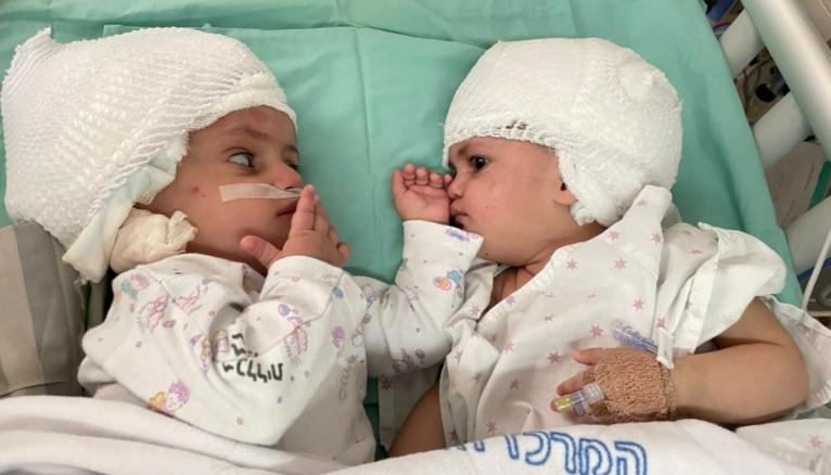 Они впервые увиделись: врачи разделили годовалых близнецов, сросшихся затылками