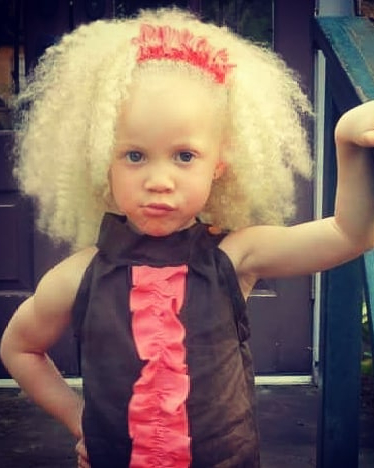 Дети-альбиносы: как выглядят, в чем их особенность