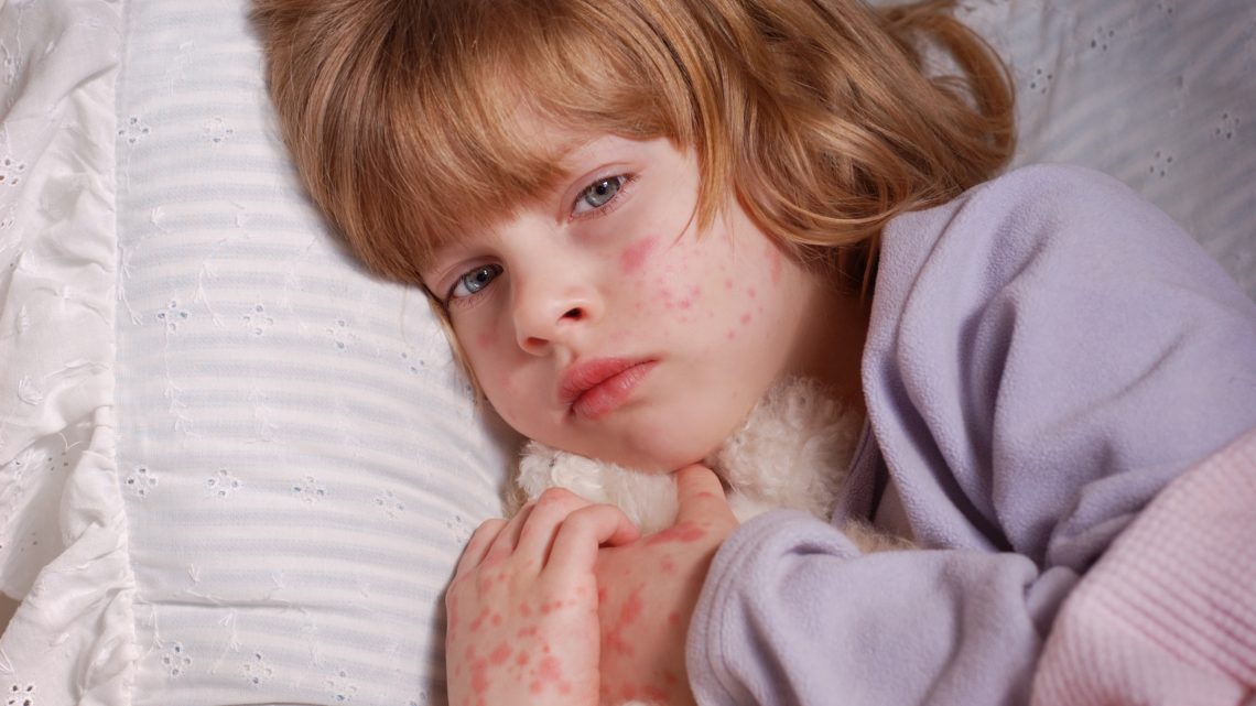 Сыпь у детей может быть единственным симптомом коронавируса