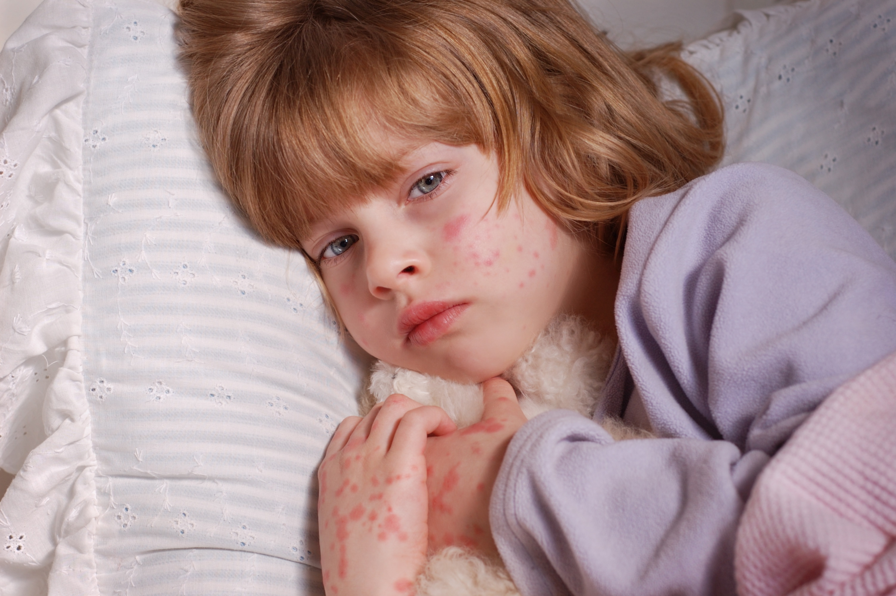 симптомы коронавируса, может ли быть сыпь при коронавирусе, симптомы коронавируса у детей, может ли быть коронавирус без температуры