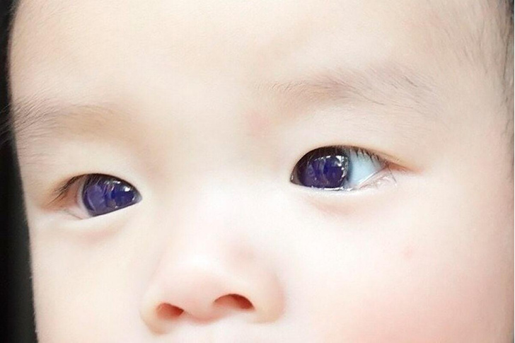Глаза стали фиолетового цвета: у мальчика после лекарства от коронавируса выявлена удивительная аномалия