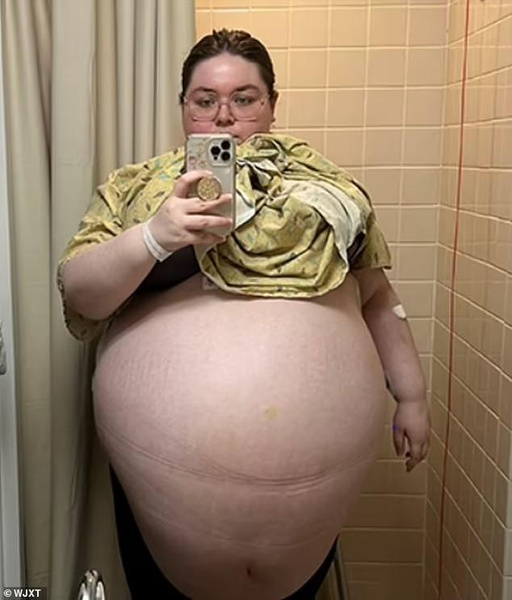 «Как будто беременна сразу десятью»: двадцатилетней американке удалили кисту яичника весом в 45 кг